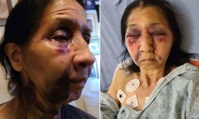 Mỹ: Cụ bà 70 tuổi bị đánh nhập viện vì giống người gốc Á
